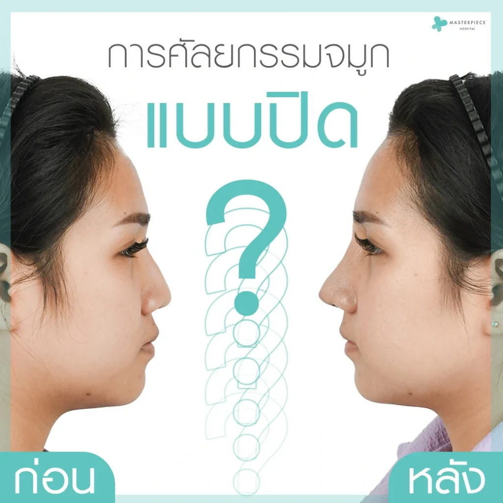 การศัลยกรรมจมูกแบบปิด (Close Rhinoplasty) คืออะไร