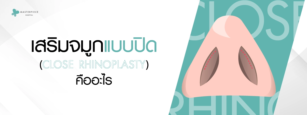 เสริมจมูกแบบปิด (Close Rhinoplasty) คืออะไร